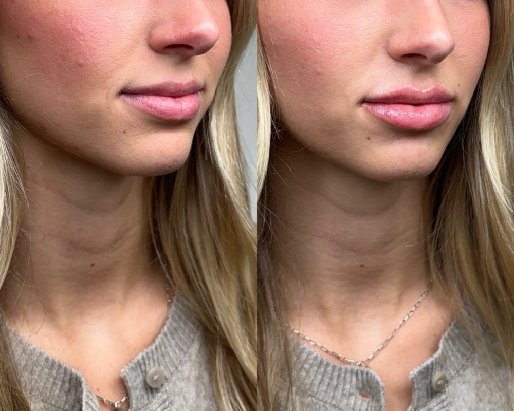 Dermal filler before and after at Temple Collective Medspa in Springfield, Illinois